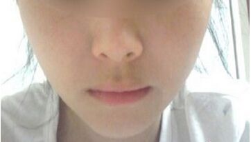 隆下巴整形手术安不降低风险 隆下巴前后对比照片图