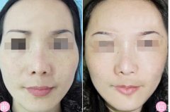 丰太阳穴的方法有哪些 丰太阳穴前后对比照