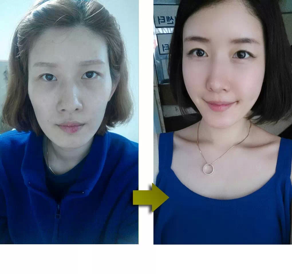 【自体脂肪丰太阳穴】自体脂肪丰太阳穴方法降低风险吗 自体脂肪丰太阳穴风险大吗