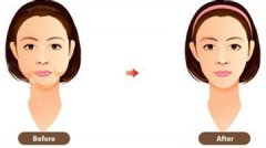 面部吸脂手术有哪些风险 面部吸脂手术后遗症