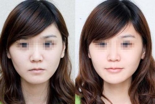 自体脂肪丰唇是怎么做的 自体脂肪丰唇有哪些特点