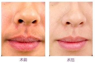 激光脱唇毛果如何 激光脱唇毛有没有副作用