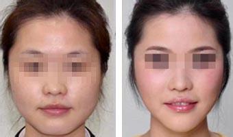 【打B****】打B****大概需要多少钱一针 打B****的注意事项