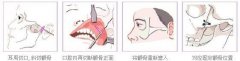 大颧骨磨骨整形价格 磨颧骨mm前后对比图