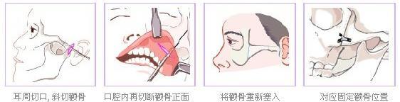 大颧骨磨骨整形价格 磨颧骨mm前后对比图