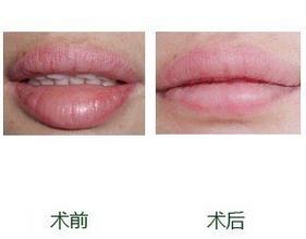 厚嘴唇整形手术缓解 嘴唇整形手术果图