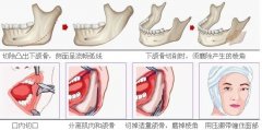 短下巴美容整形术 短下巴整形前后对比照 短下巴美容整形术 短下巴整形前后对比照