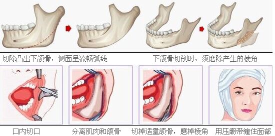 短下巴美容整形术 短下巴整形前后对比照