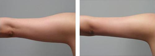 手臂吸脂减肥有什么优势 手臂吸脂价格多少