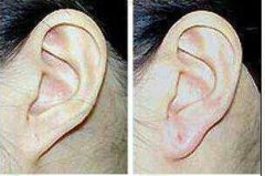 丰耳垂有哪几种方法 丰耳垂前后对比照