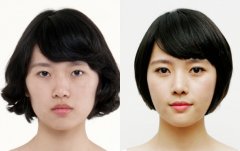 玻尿酸隆鼻果怎么样 玻尿酸隆鼻前后果图