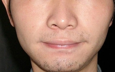 激光脱胡子 轻松甩掉大叔形象