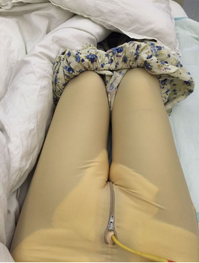 大腿部吸脂减肥 我终于拥有笔直修长的双腿了