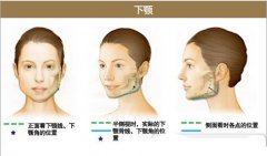 宽下颌角整形手术 下颌角肥大矫正手术