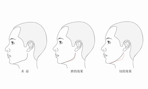 做下颌角整形术价格 下颌角整形术全过程
