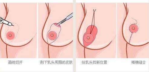 乳房下垂矫正手术后会再松弛吗