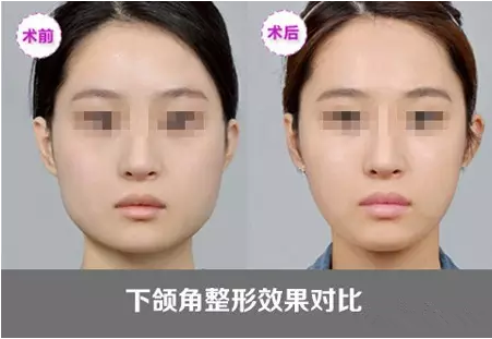 下颌角截骨整形大概多少钱 下颌角截骨整形术全过程