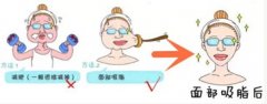 面部吸脂手术后遗症 面部吸脂手术果图