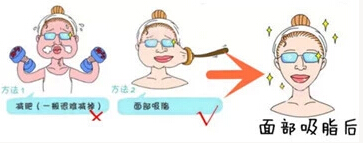 面部吸脂手术后遗症 面部吸脂手术果图