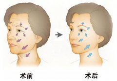 面部填充术**吗 面部填充果怎么样