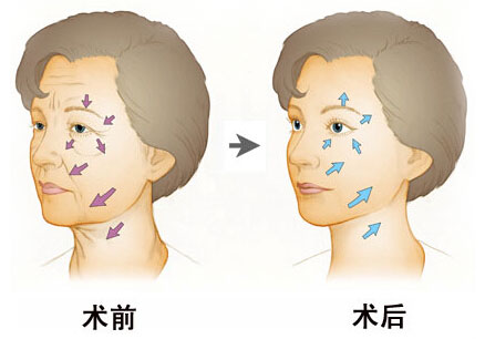 面部填充术**吗 面部填充果怎么样
