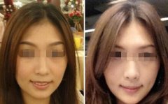 玻尿酸隆下巴成好吗 玻尿酸隆下巴对比图 玻尿酸隆下巴成好吗 玻尿酸隆下巴对比图