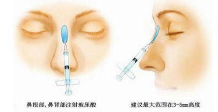 自体脂肪注射隆鼻好还是玻尿酸注射隆鼻好