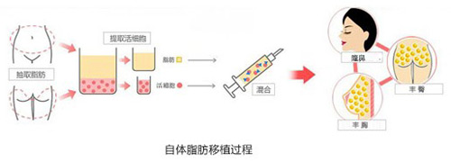自体脂肪注射隆鼻好还是玻尿酸注射隆鼻好