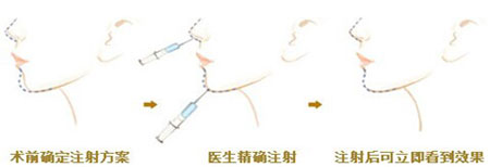 下巴垫出高颜值 垫下巴需要多少钱