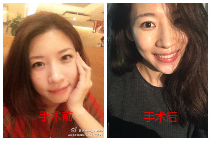 垫下巴假体要注意什么 假体垫下巴前后对比图