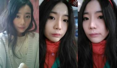 垫下巴假体要注意什么 假体垫下巴前后对比图