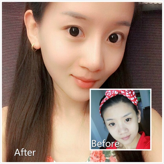注射打B****前后对比真人照片果案例图