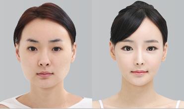 杭州下颌角截骨整形手术多少钱