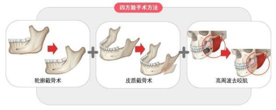杭州下颌角截骨整形手术多少钱