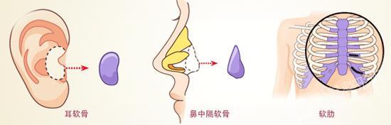 自体耳软骨隆鼻 GET**鼻形标准