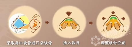 自体耳软骨隆鼻 GET**鼻形标准