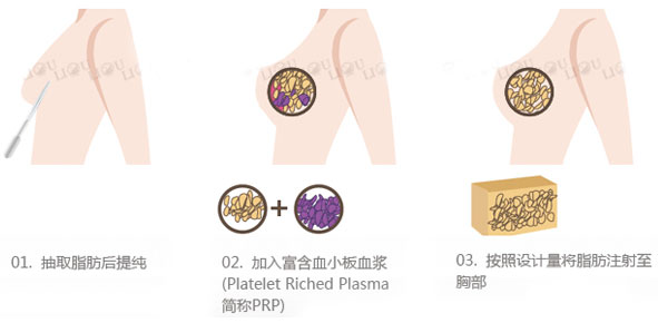 自体脂肪移植隆胸术后胸又小了怎么办