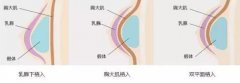 丰胸大小与哪些有关 丰胸到底多大合适