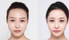 膨体隆鼻术的果能保持多久 膨体隆鼻术的果能保持多久