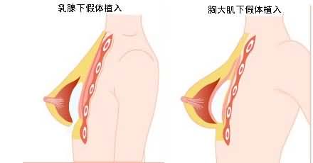 进口的假体和国产的假体有什么区别 哪个理想果更好