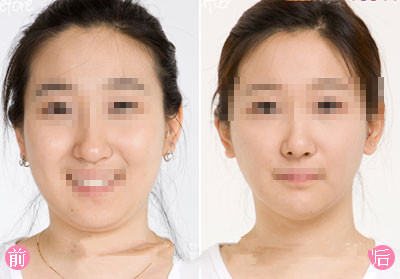 颊脂肪垫摘除瘦脸术 去颊脂垫前后对比效果案例图