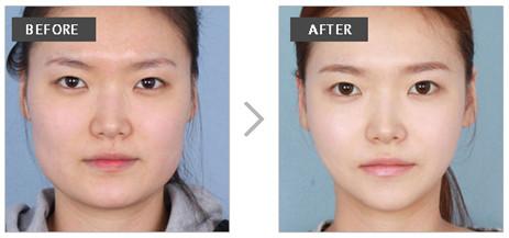 改变脸型的整形方法 韩式精致微创改脸型大概要多少钱