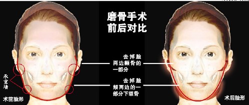 改变脸型的整形方法 韩式精致微创改脸型大概要多少钱
