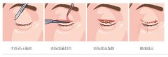 割双眼皮需要多久能基本恢复自然