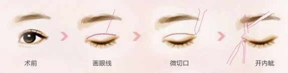 什么手术能做成理想的双眼皮