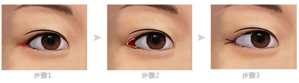 割双眼皮术后该怎么护理