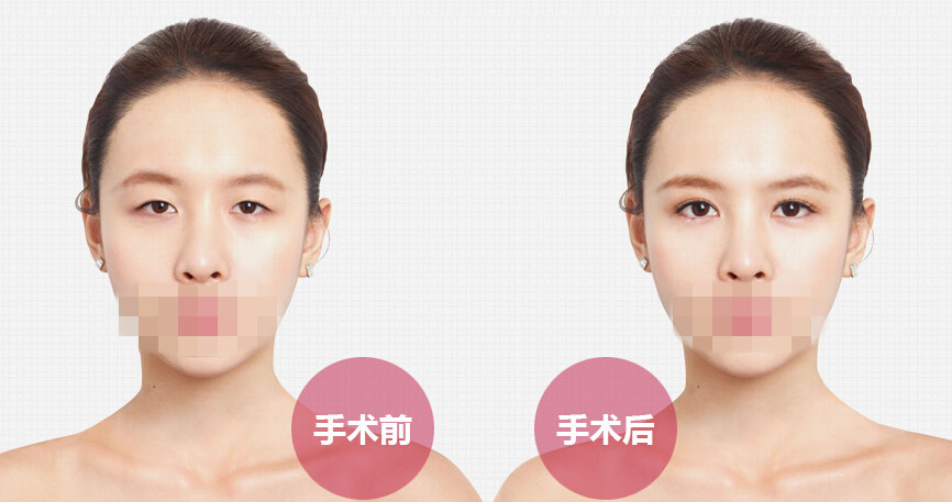 埋线双眼皮拆线后多久可以洗脸
