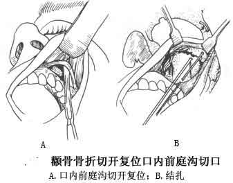颧骨整形手术方法有哪些 颧骨整形手术流程