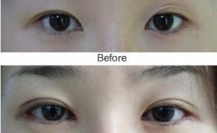 双眼皮修复手术适应症 双眼皮修复术后注意
