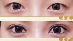 双眼皮修复价格贵吗 双眼皮修复多少钱